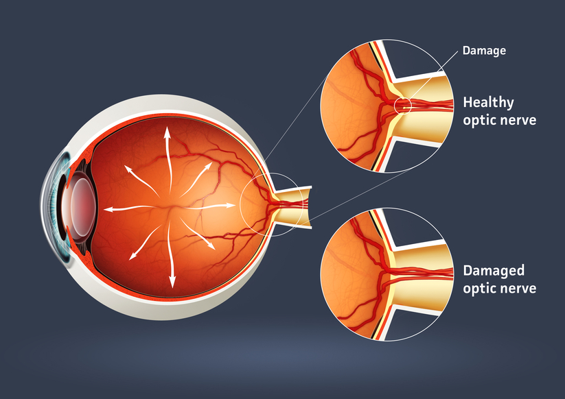glaucoma article