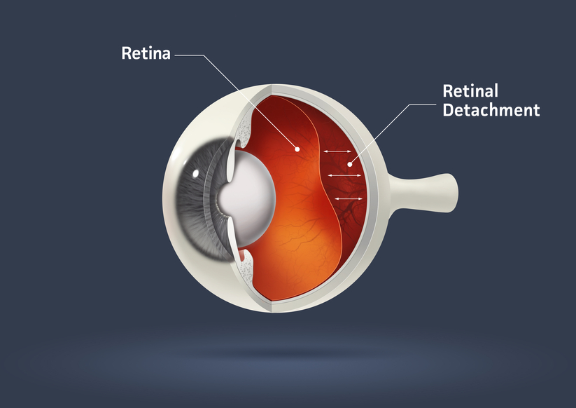 retinal detachment article